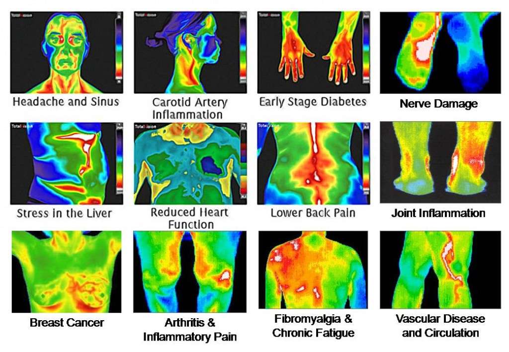 thermal imaging for medical purposes